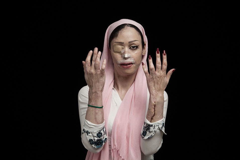 Impactantes fotografías que denuncian los ataques con ácido en Irán 02