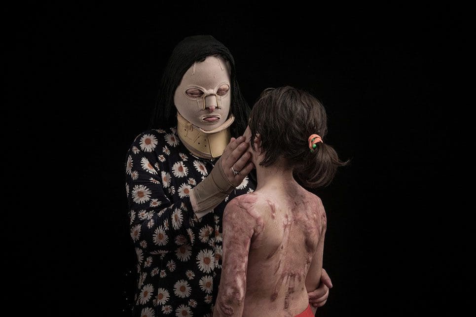 Impactantes fotografías que denuncian los ataques con ácido en Irán 03