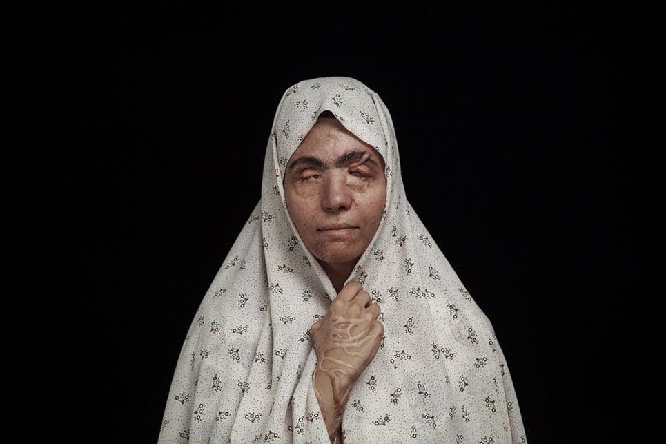 Impactantes fotografías que denuncian los ataques con ácido en Irán 05