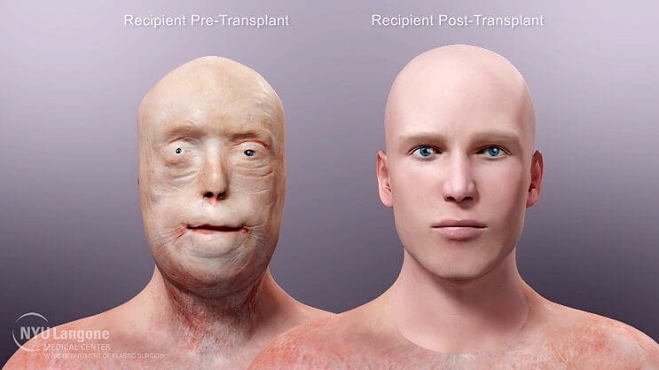 Patrick Hardison transplante rostro operacion